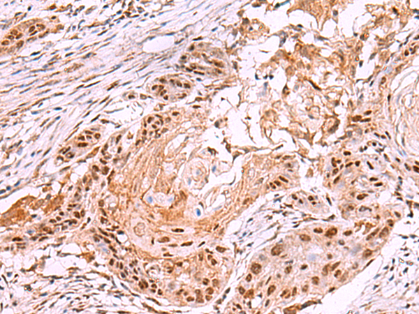 Immunohistochemistry of paraffin-embedded Human esophagus cancer tissue  using IRX4 Polyclonal Antibody at dilution of 1:35(×200)