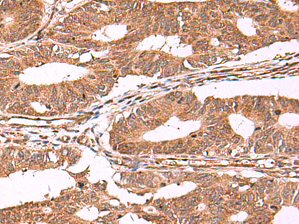 Immunohistochemistry of paraffin-embedded Human colorectal cancer tissue  using IST1 Polyclonal Antibody at dilution of 1:40(×200)