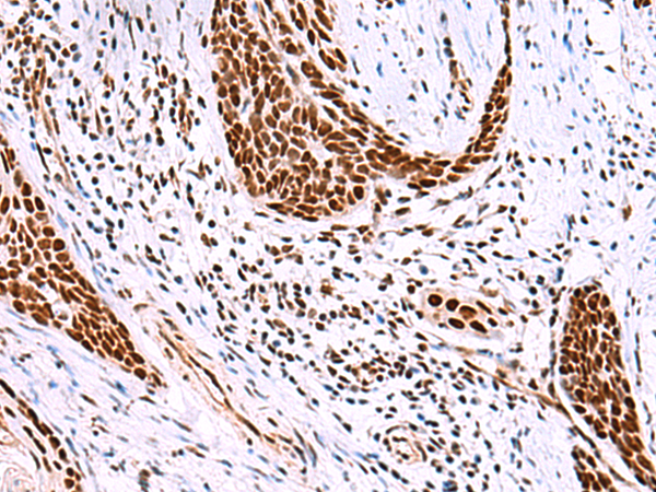 Immunohistochemistry of paraffin-embedded Human esophagus cancer tissue  using ISY1-RAB43 Polyclonal Antibody at dilution of 1:30(×200)