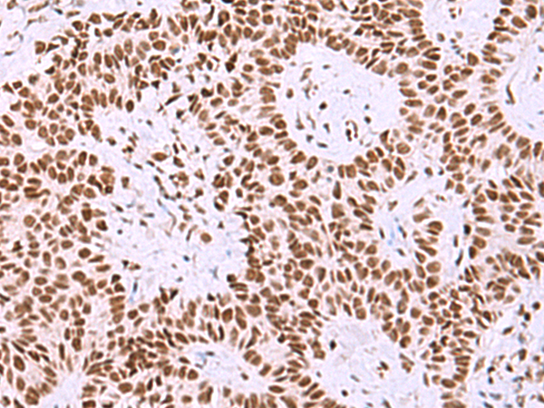 Immunohistochemistry of paraffin-embedded Human ovarian cancer tissue  using ISY1-RAB43 Polyclonal Antibody at dilution of 1:30(×200)