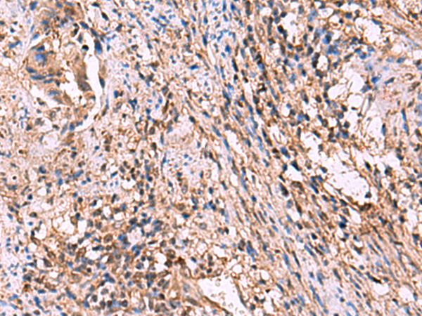 Immunohistochemistry of paraffin-embedded Human cervical cancer tissue  using ITIH4 Polyclonal Antibody at dilution of 1:30(×200)