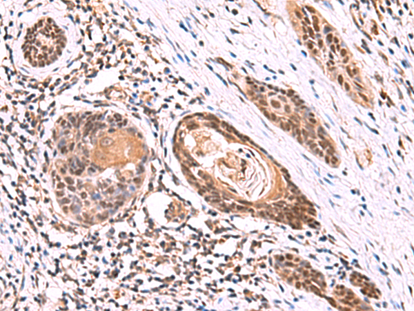 Immunohistochemistry of paraffin-embedded Human esophagus cancer tissue  using ITPR2 Polyclonal Antibody at dilution of 1:60(×200)