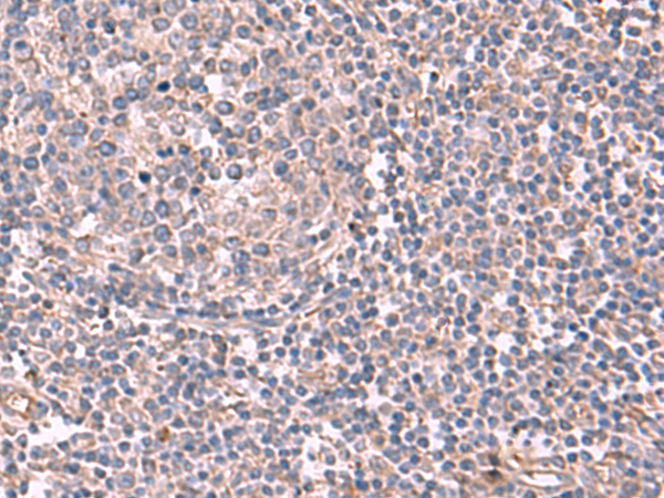 Immunohistochemistry of paraffin-embedded Human tonsil tissue  using JAZF1 Polyclonal Antibody at dilution of 1:55(×200)