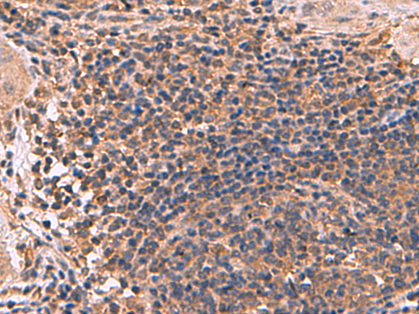 Immunohistochemistry of paraffin-embedded Human cervical cancer tissue  using ZBTB33 Polyclonal Antibody at dilution of 1:30(×200)