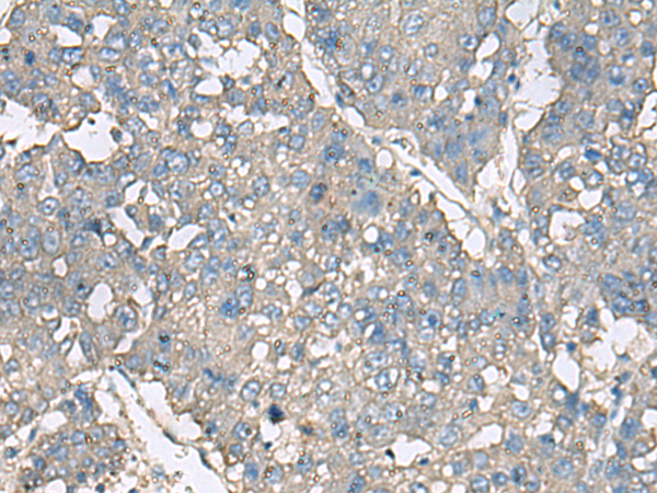 Immunohistochemistry of paraffin-embedded Human liver cancer tissue  using TNF Polyclonal Antibody at dilution of 1:40(×200)