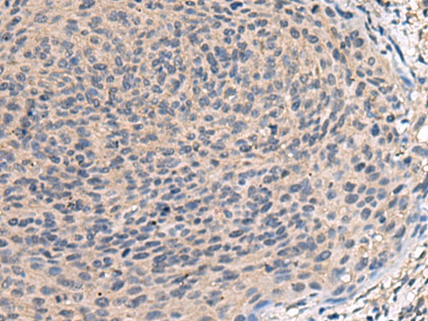 Immunohistochemistry of paraffin-embedded Human cervical cancer tissue  using TNF Polyclonal Antibody at dilution of 1:40(×200)