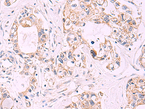 Immunohistochemistry of paraffin-embedded Human gastric cancer tissue  using TNF Polyclonal Antibody at dilution of 1:40(×200)