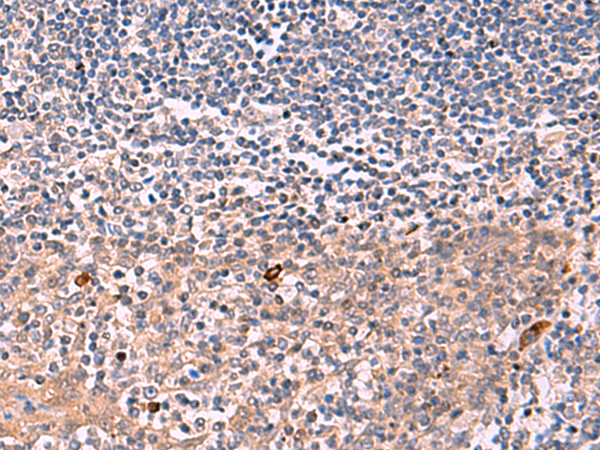 Immunohistochemistry of paraffin-embedded Human tonsil tissue  using IFNA1:IFNA13 Polyclonal Antibody at dilution of 1:35(×200)