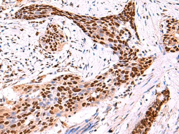 Immunohistochemistry of paraffin-embedded Human esophagus cancer tissue  using SOX2 Polyclonal Antibody at dilution of 1:50(×200)