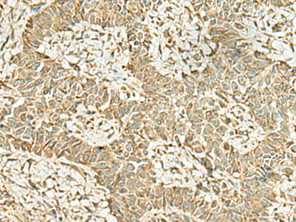 Immunohistochemistry of paraffin-embedded Human ovarian cancer tissue  using KAT7 Polyclonal Antibody at dilution of 1:45(×200)