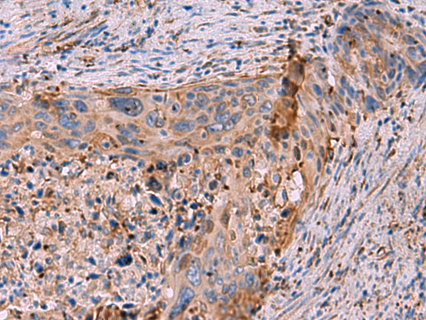 Immunohistochemistry of paraffin-embedded Human cervical cancer tissue  using KBTBD11 Polyclonal Antibody at dilution of 1:35(×200)