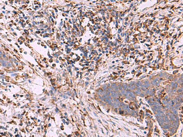 Immunohistochemistry of paraffin-embedded Human esophagus cancer tissue  using G6PC Polyclonal Antibody at dilution of 1:70(×200)