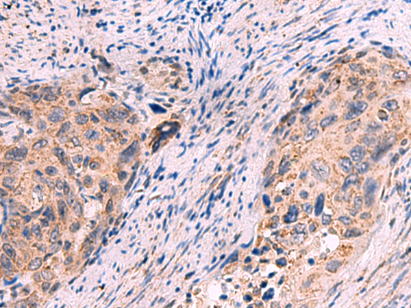 Immunohistochemistry of paraffin-embedded Human cervical cancer tissue  using KCNN1 Polyclonal Antibody at dilution of 1:55(×200)