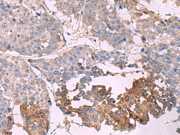 Immunohistochemistry of paraffin-embedded Human liver cancer tissue  using NIPSNAP1 Polyclonal Antibody at dilution of 1:35(×200)