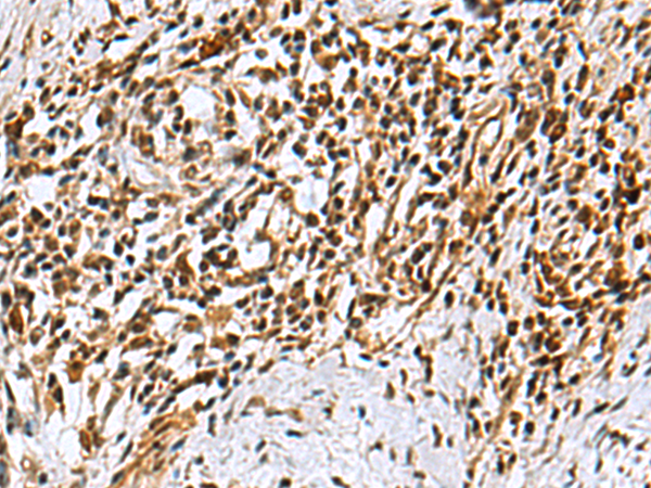 Immunohistochemistry of paraffin-embedded Human esophagus cancer tissue  using KDM2B Polyclonal Antibody at dilution of 1:40(×200)