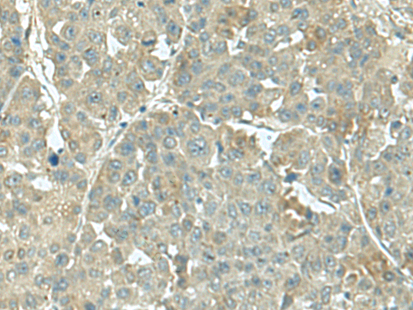 Immunohistochemistry of paraffin-embedded Human liver cancer tissue  using KRT36 Polyclonal Antibody at dilution of 1:55(×200)