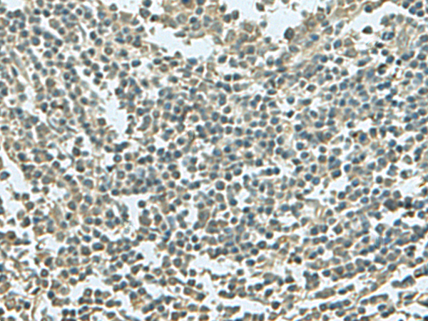 Immunohistochemistry of paraffin-embedded Human tonsil tissue  using KRT36 Polyclonal Antibody at dilution of 1:55(×200)