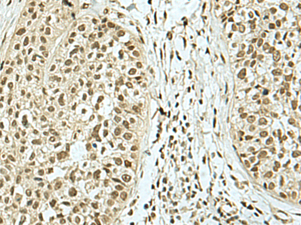 Immunohistochemistry of paraffin-embedded Human esophagus cancer tissue  using KHSRP Polyclonal Antibody at dilution of 1:40(×200)