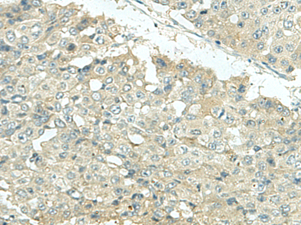 Immunohistochemistry of paraffin-embedded Human liver cancer tissue  using KIR2DL5A Polyclonal Antibody at dilution of 1:35(×200)