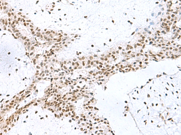 Immunohistochemistry of paraffin-embedded Human breast cancer tissue  using PUM3 Polyclonal Antibody at dilution of 1:80(×200)