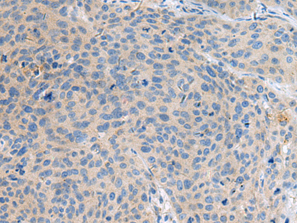 Immunohistochemistry of paraffin-embedded Human cervical cancer tissue  using KIAA0556 Polyclonal Antibody at dilution of 1:90(×200)