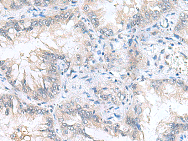 Immunohistochemistry of paraffin-embedded Human lung cancer tissue  using CAMSAP3 Polyclonal Antibody at dilution of 1:90(×200)