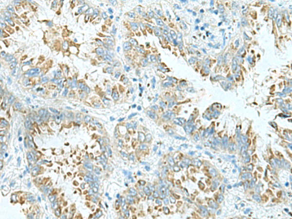 Immunohistochemistry of paraffin-embedded Human lung cancer tissue  using SHTN1 Polyclonal Antibody at dilution of 1:30(×200)
