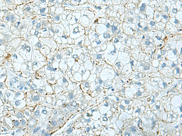Immunohistochemistry of paraffin-embedded Human liver cancer tissue  using SHTN1 Polyclonal Antibody at dilution of 1:30(×200)