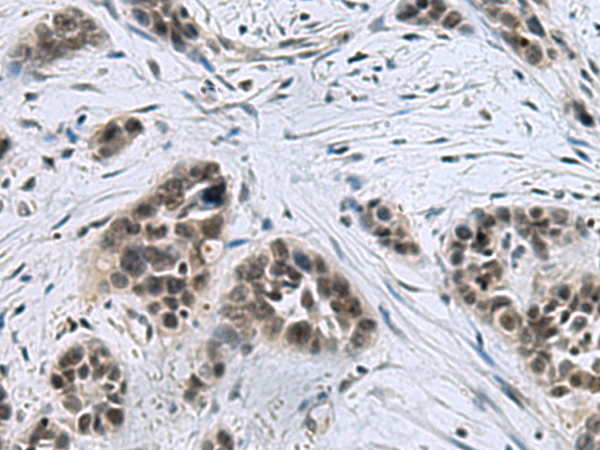 Immunohistochemistry of paraffin-embedded Human thyroid cancer tissue  using CCAR2 Polyclonal Antibody at dilution of 1:40(×200)