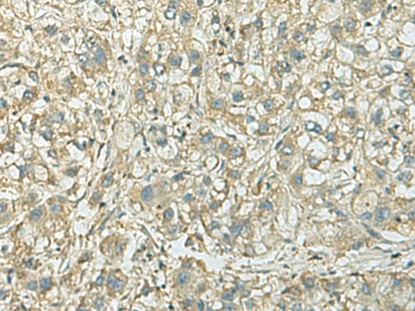 Immunohistochemistry of paraffin-embedded Human liver cancer tissue  using KIF21B Polyclonal Antibody at dilution of 1:40(×200)