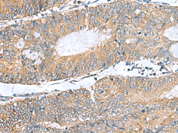 Immunohistochemistry of paraffin-embedded Human colorectal cancer tissue  using NFKB1 Polyclonal Antibody at dilution of 1:50(×200)