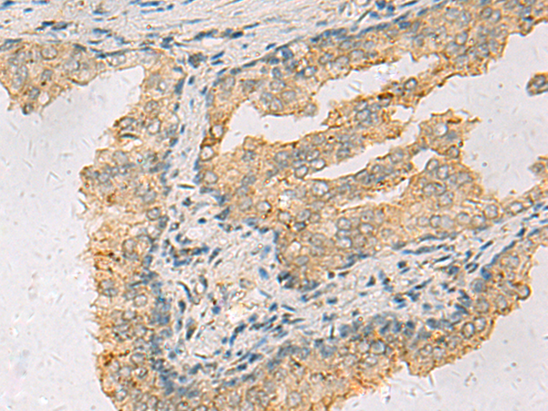 Immunohistochemistry of paraffin-embedded Human prost ate cancer tissue  using ANXA13 Polyclonal Antibody at dilution of 1:105(×200)