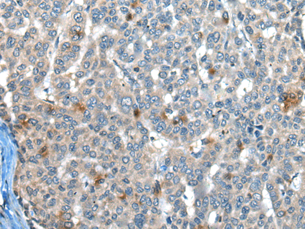 Immunohistochemistry of paraffin-embedded Human liver cancer tissue  using CAPN3 Polyclonal Antibody at dilution of 1:30(×200)