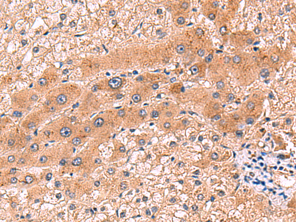 Immunohistochemistry of paraffin-embedded Human liver cancer tissue  using CCL13 Polyclonal Antibody at dilution of 1:90(×200)