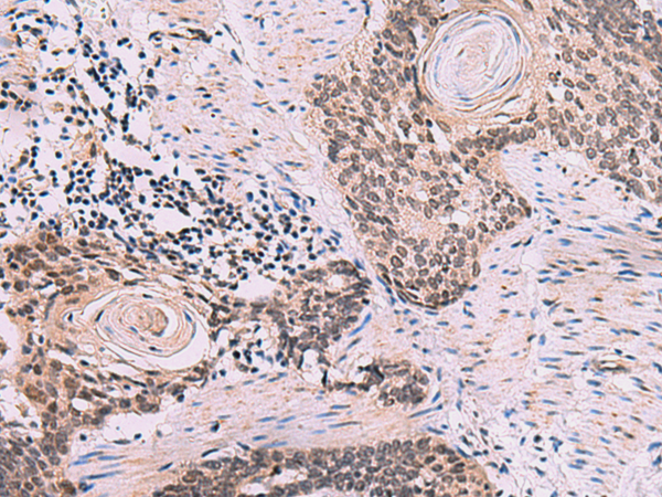 Immunohistochemistry of paraffin-embedded Human esophagus cancer tissue  using CDK4 Polyclonal Antibody at dilution of 1:60(×200)