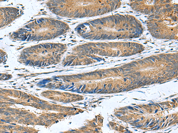 Immunohistochemistry of paraffin-embedded Human colorectal cancer tissue  using CLEC1B Polyclonal Antibody at dilution of 1:55(×200)
