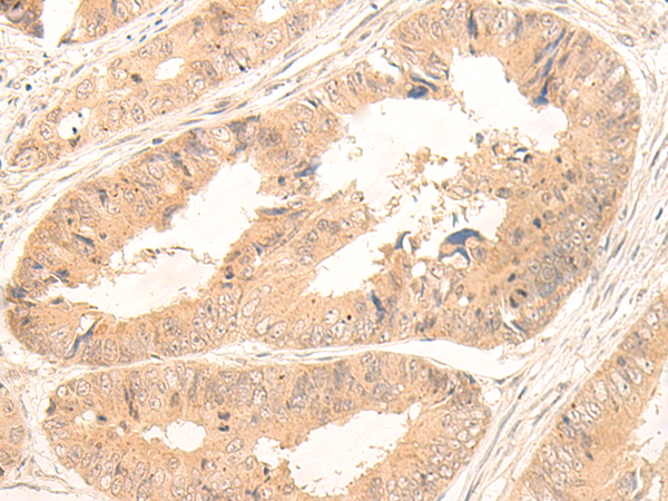 Immunohistochemistry of paraffin-embedded Human colorectal cancer tissue  using FABP4 Polyclonal Antibody at dilution of 1:65(×200)