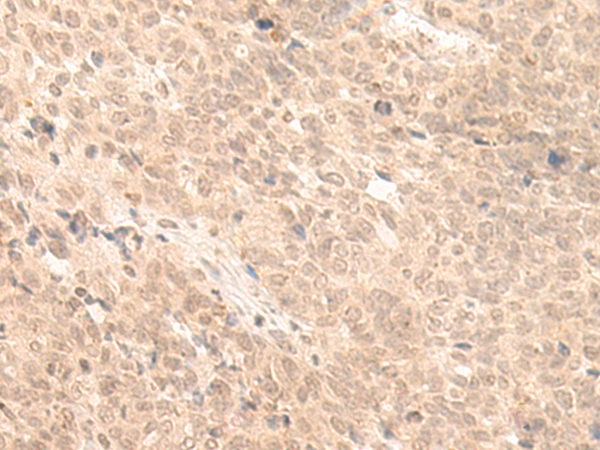 Immunohistochemistry of paraffin-embedded Human ovarian cancer tissue  using FABP4 Polyclonal Antibody at dilution of 1:65(×200)