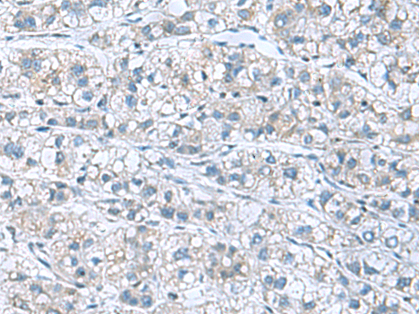 Immunohistochemistry of paraffin-embedded Human liver cancer tissue  using GDF9 Polyclonal Antibody at dilution of 1:55(×200)