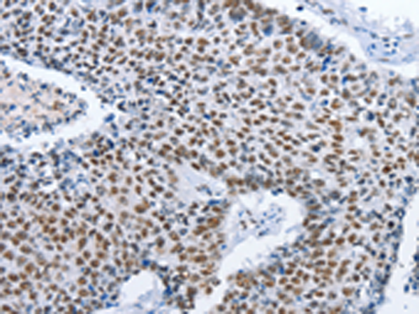 Immunohistochemistry of paraffin-embedded Human lung cancer tissue  using GNRH1 Polyclonal Antibody at dilution of 1:70(×200)