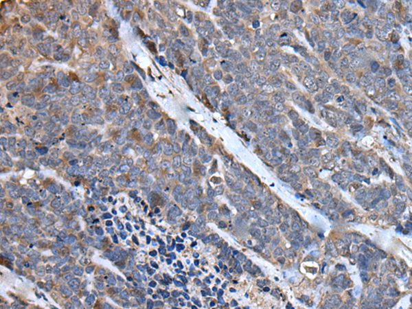 Immunohistochemistry of paraffin-embedded Human thyroid cancer tissue  using MCM10 Polyclonal Antibody at dilution of 1:50(×200)