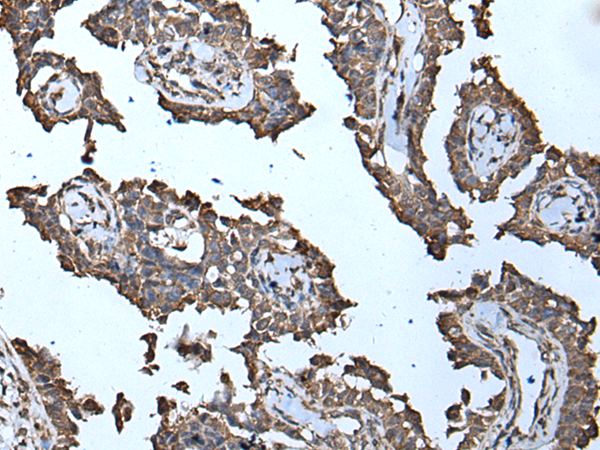 Immunohistochemistry of paraffin-embedded Human ovarian cancer tissue  using MCM10 Polyclonal Antibody at dilution of 1:50(×200)