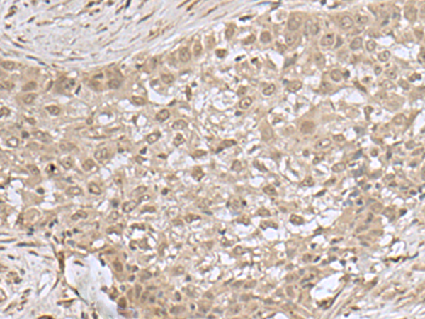 Immunohistochemistry of paraffin-embedded Human esophagus cancer tissue  using NEUROG3 Polyclonal Antibody at dilution of 1:55(×200)