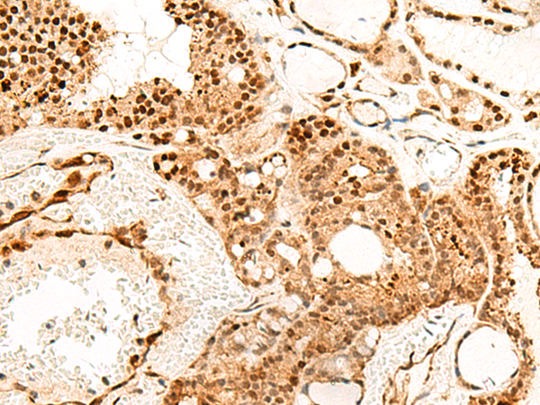 Immunohistochemistry of paraffin-embedded Human thyroid cancer tissue  using PDCD4 Polyclonal Antibody at dilution of 1:35(×200)