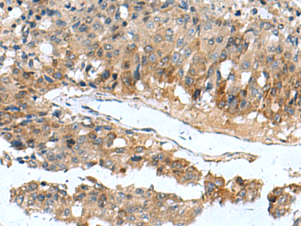 Immunohistochemistry of paraffin-embedded Human liver cancer tissue  using PDCD5 Polyclonal Antibody at dilution of 1:105(×200)