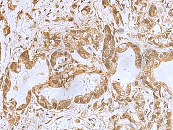 Immunohistochemistry of paraffin-embedded Human gastric cancer tissue  using PHF6 Polyclonal Antibody at dilution of 1:85(×200)
