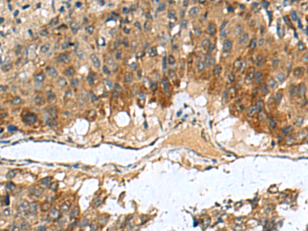 Immunohistochemistry of paraffin-embedded Human liver cancer tissue  using TGM3 Polyclonal Antibody at dilution of 1:110(×200)