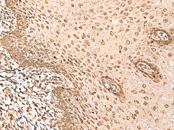 Immunohistochemistry of paraffin-embedded Human esophagus cancer tissue  using BAP1 Polyclonal Antibody at dilution of 1:35(×200)