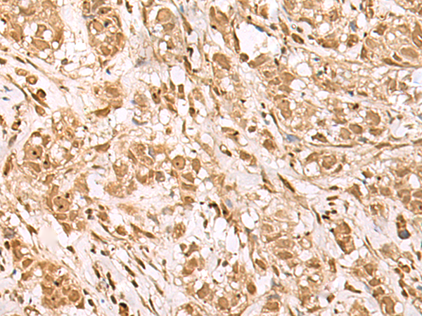 Immunohistochemistry of paraffin-embedded Human breast cancer tissue  using BAP1 Polyclonal Antibody at dilution of 1:35(×200)