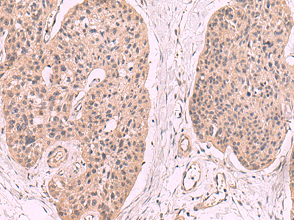Immunohistochemistry of paraffin-embedded Human esophagus cancer tissue  using KLRB1 Polyclonal Antibody at dilution of 1:55(×200)